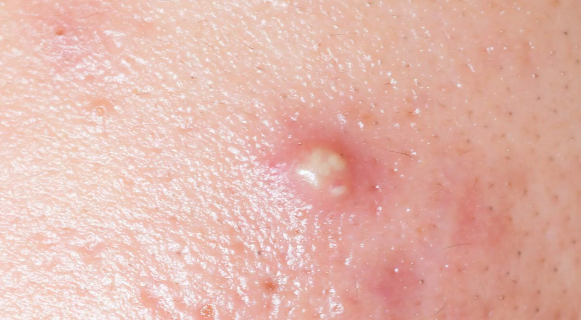 Boils: Causes, Symptoms and Treatments