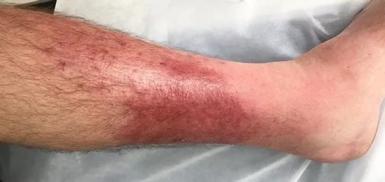 Cellulitis: Causes, Symptoms and Treatments