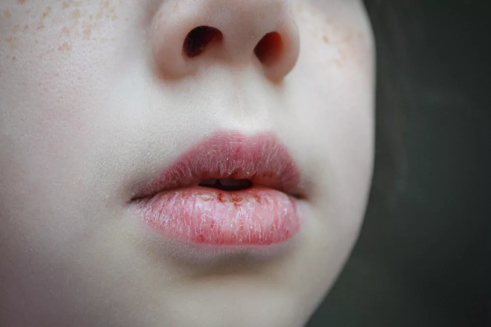 Chapped Lips: Causes, Symptoms and Treatments