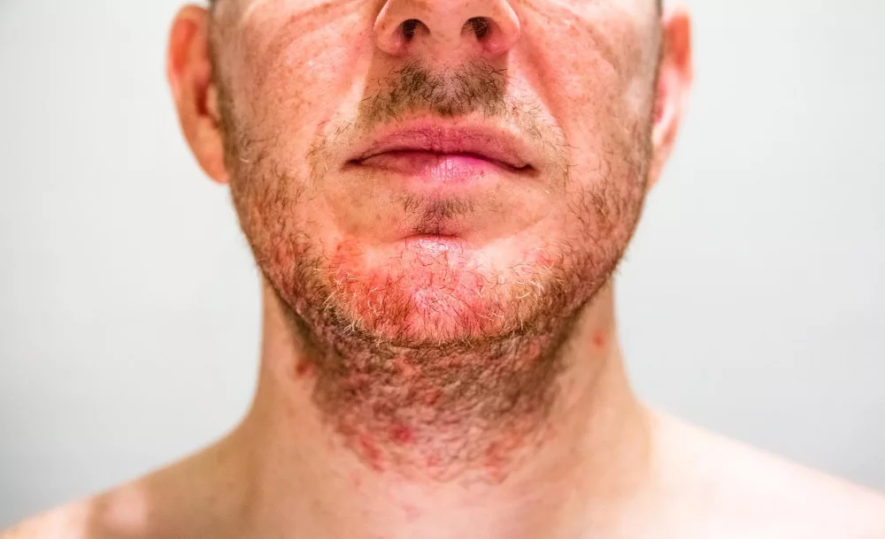 Folliculitis