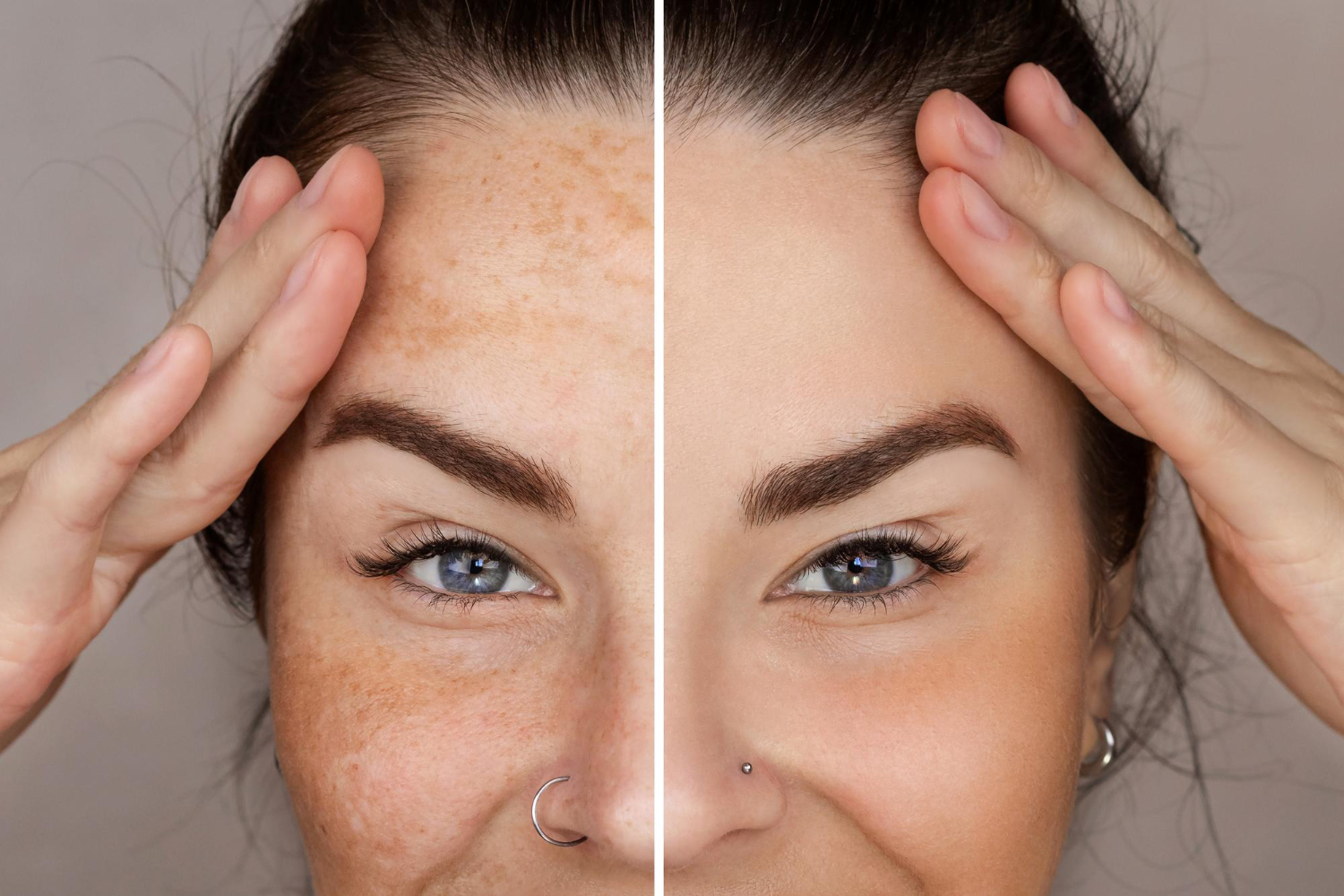 Before and after pigmentation improvement